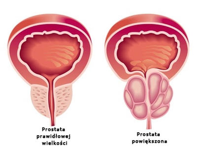 prostata schemat2